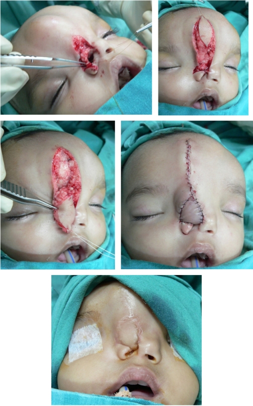 Case 12 B: A forehead flap of skin based on a subcutaneous pedicle has been rotated to close the defect created by the movement of tissue used to create the nostril.