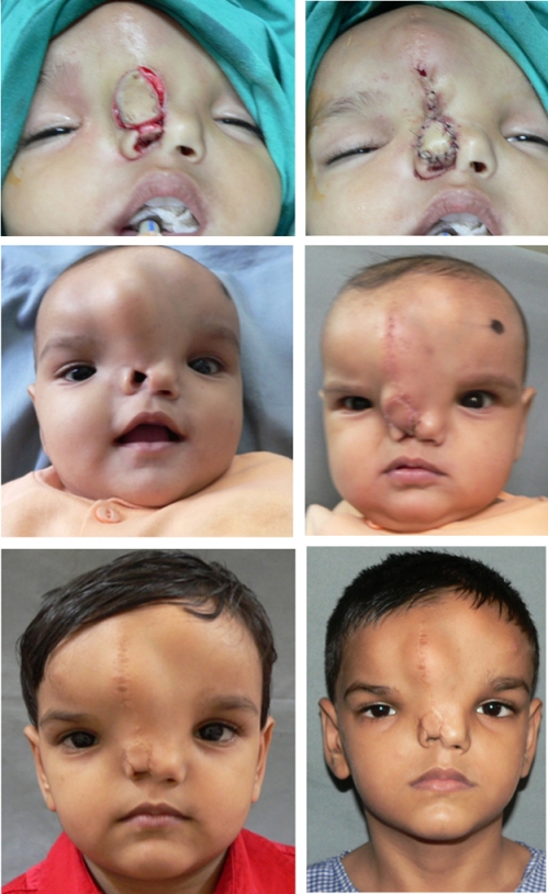 Case 12 C: The upper photographs show the steps so far taken. The lower two photographs show the reconstructed alar area has been defattened and the meningeal bulge in the forehead has considerably reduced because of plication of soft tissue surrounding the bony defect.