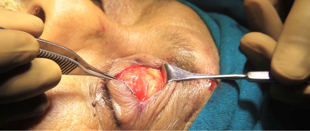 Just above the tarsus can be seen pre-apineurotic fatty tissue which is gently retracted.