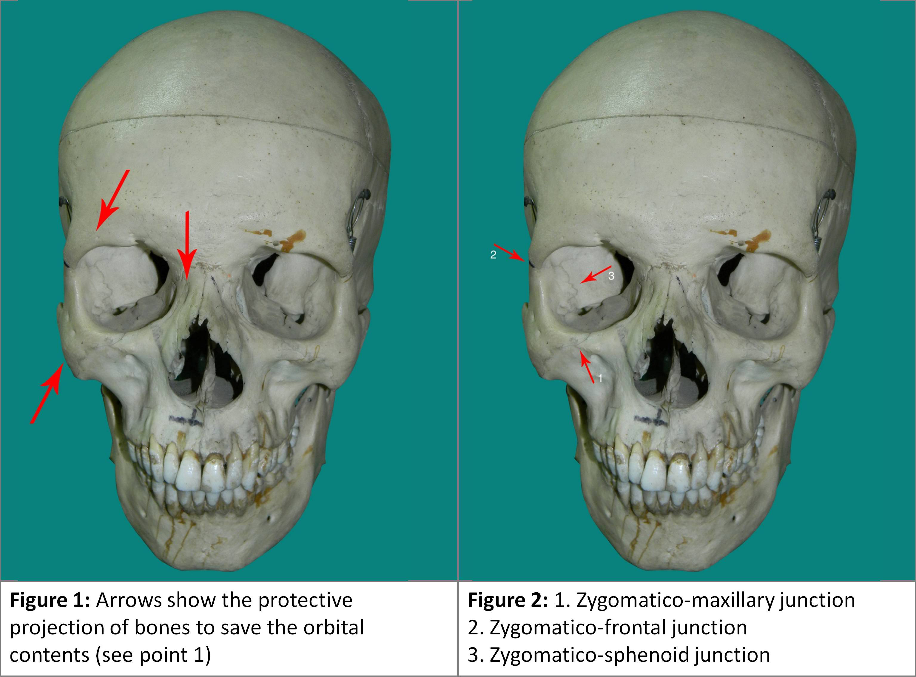 What is the common name for the zygomatic bone?